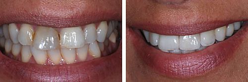 vorher - nach | Bleaching und Veneers