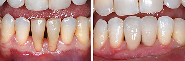 Den schneidezähnen zahnlücke zwischen grosse Zahnlücke schließen:
